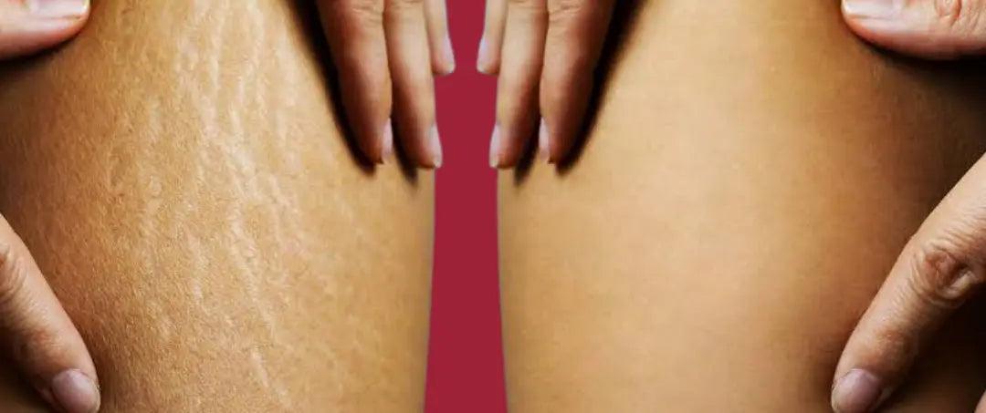 Postpartum Stretch Marks: Why They Happen and How to Fade Them Naturally