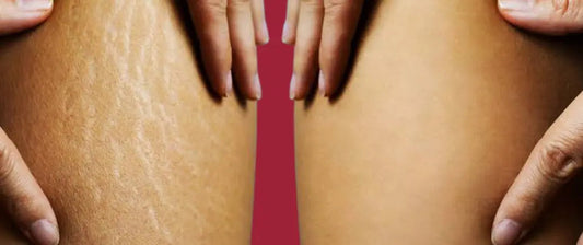 Postpartum Stretch Marks: Why They Happen and How to Fade Them Naturally