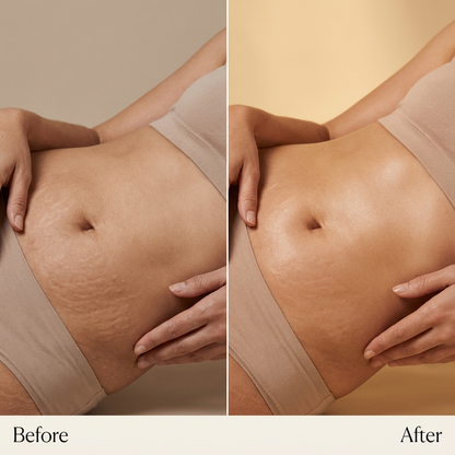 Stretch Mark Renewal Cream