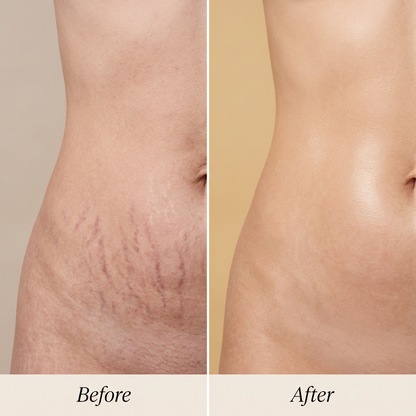 Cellulite & Stretch Mark Cream Duo
