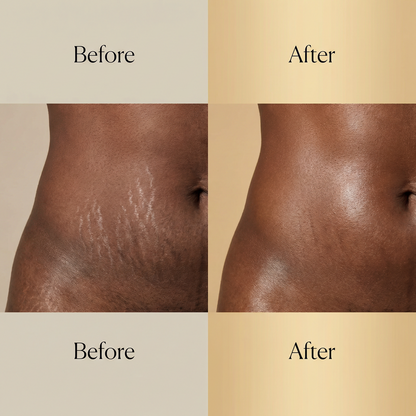 Stretch Mark Renewal Cream
